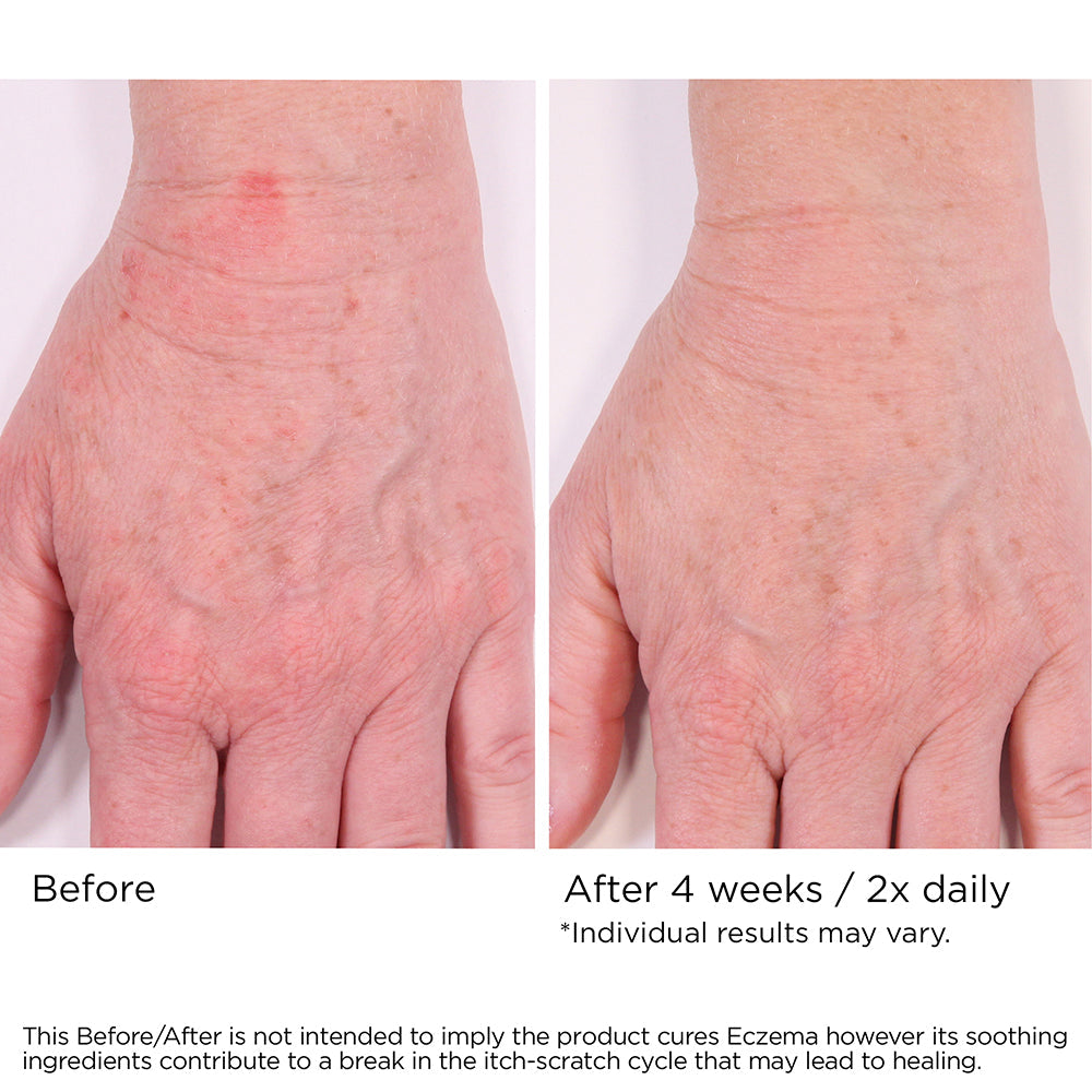 Eczema Cream