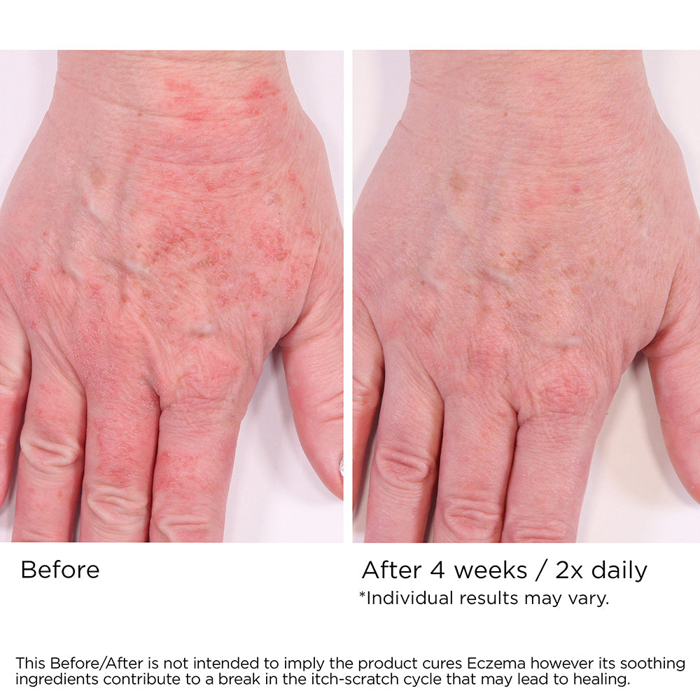 Eczema Cream