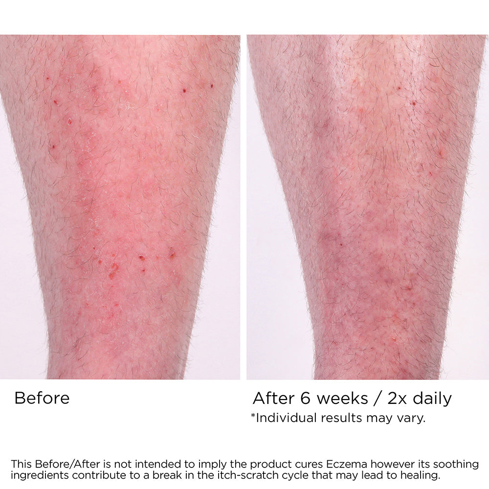 Eczema Cream